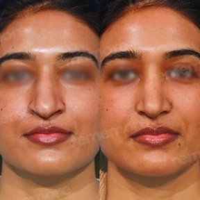 Rhinoplasty (nose job) - photo 3