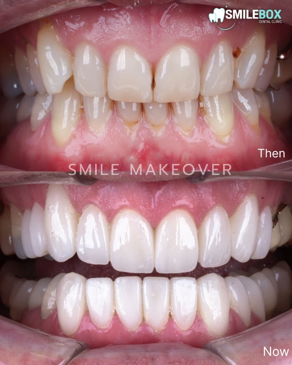 До та після результату Hollywood Smile у SmileBox Dental Clinic - Thonglor, Sukhumvit Branch
