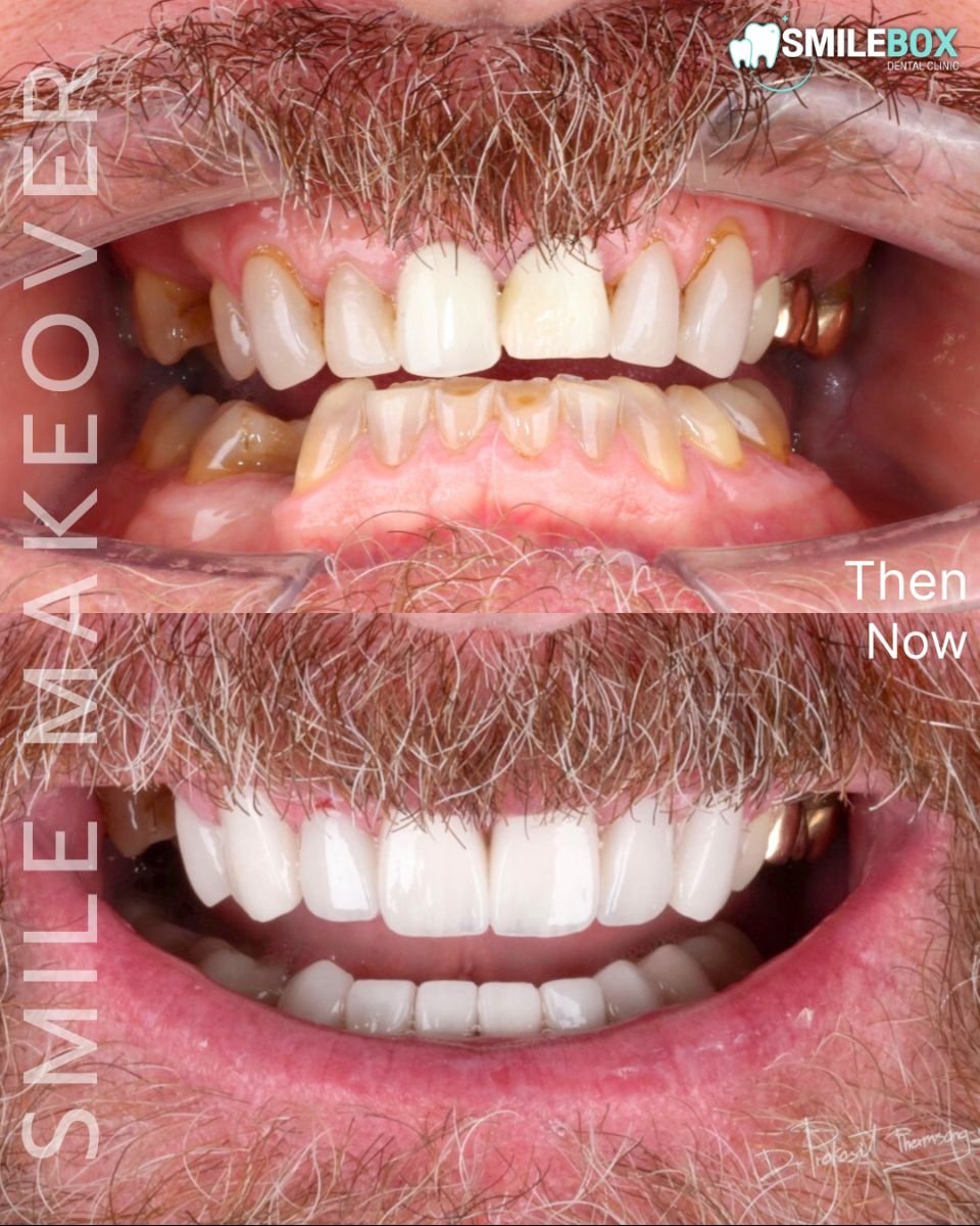 نتائج قبل وبعد تجميل الابتسامة بالفينير في SmileBox Dental Clinic Thonglor