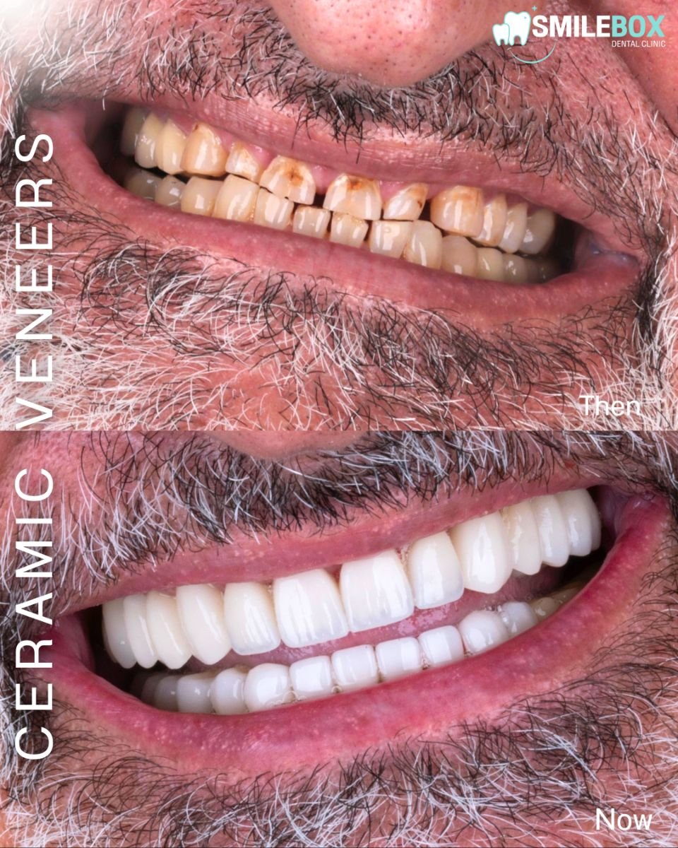 Resultado antes y después de carillas cerámicas en SmileBox Dental Clinic - Thonglor, Sukhumvit Branch