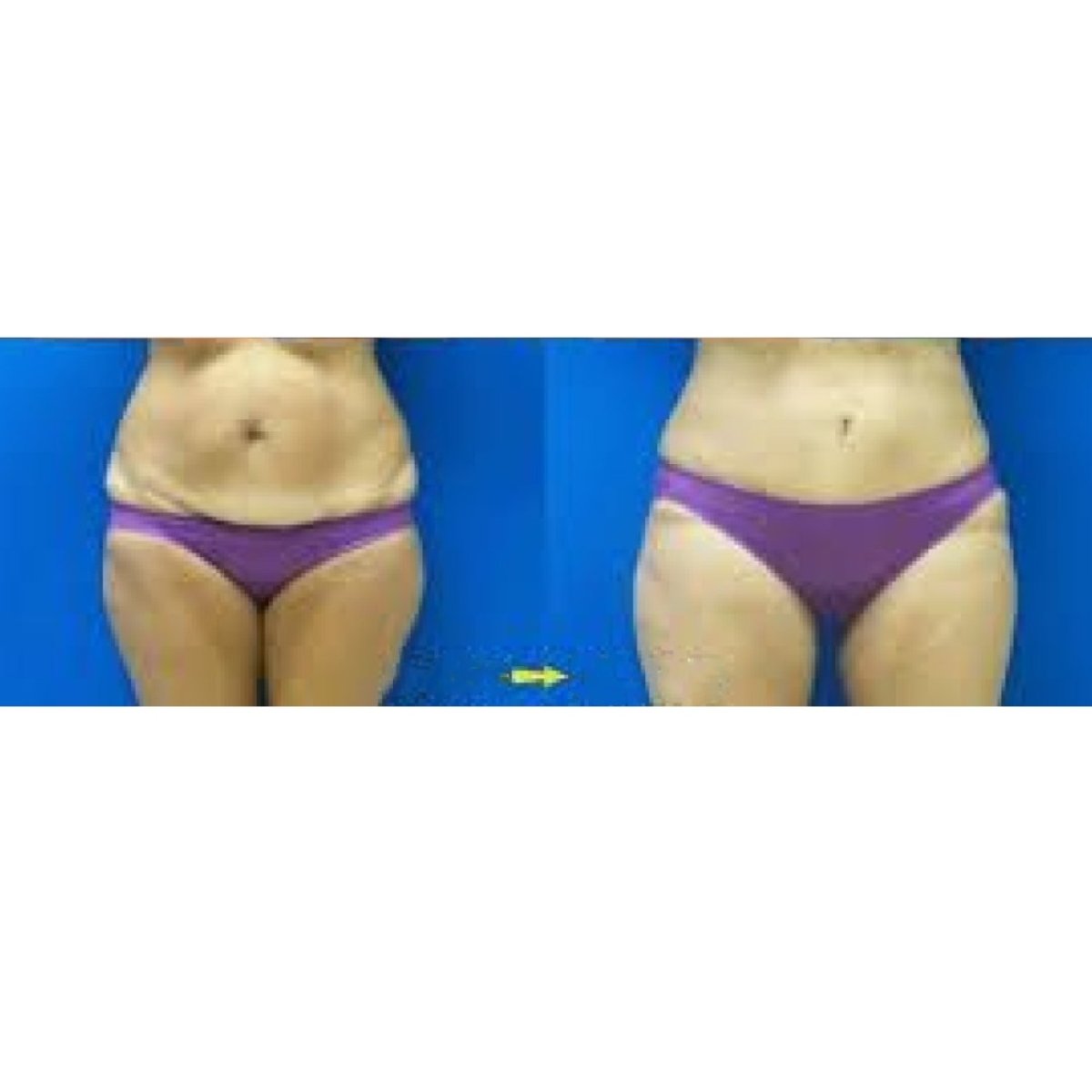 Результаты липосакции до и после в Odontoliuzzi Dentistry and Health, улучшенный контур тела