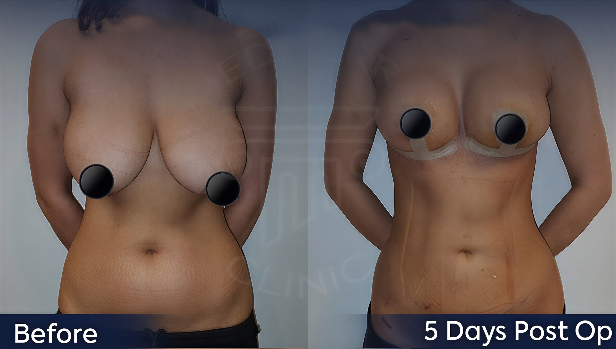 Resultados antes y después de implantes y levantamiento de senos en Dr. Safa Manav Clinic