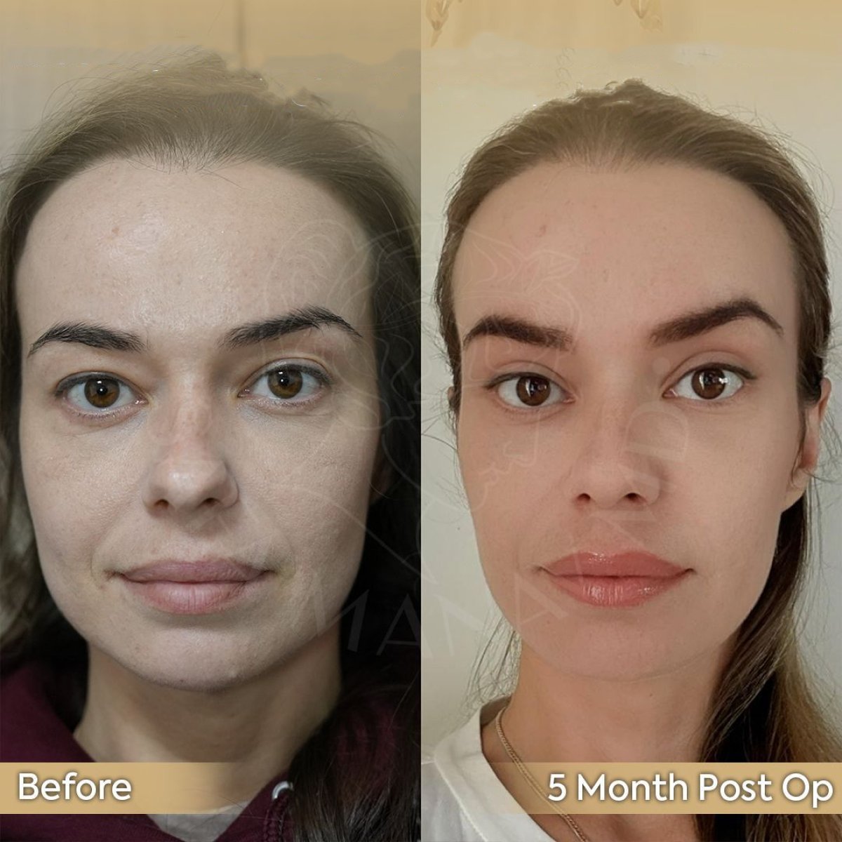 Résultats lifting des sourcils avant/après à la clinique Dr. Safa Manav, 5 mois post-op