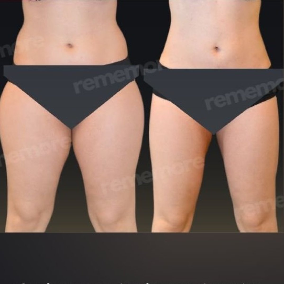 Before and after liposuction results at Memorial Şişli Hospital, improved body contour