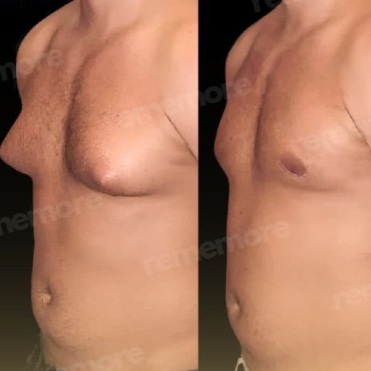 Before and after gynecomastia surgery results at Memorial Şişli Hospital, male chest contouring