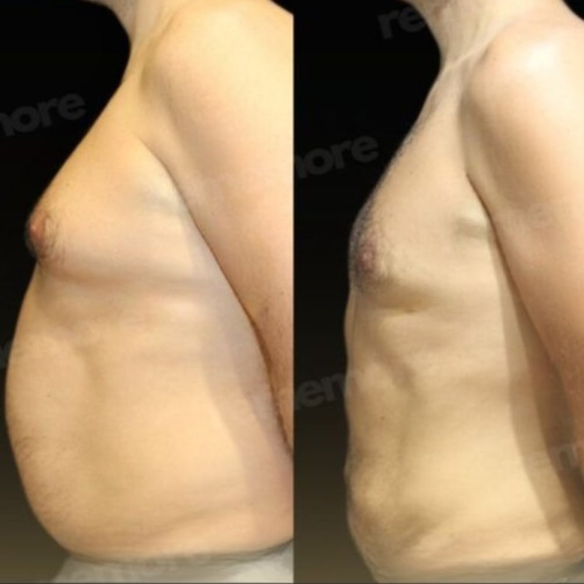 Before and after liposuction results at Memorial Şişli Hospital, visible abdominal contouring