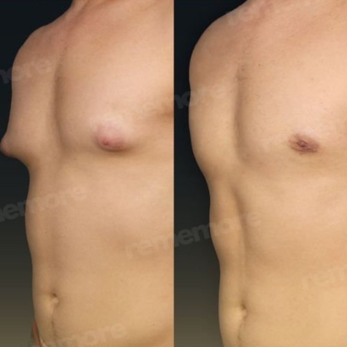 Before and after liposuction results at Memorial Şişli Hospital, improved male chest contour