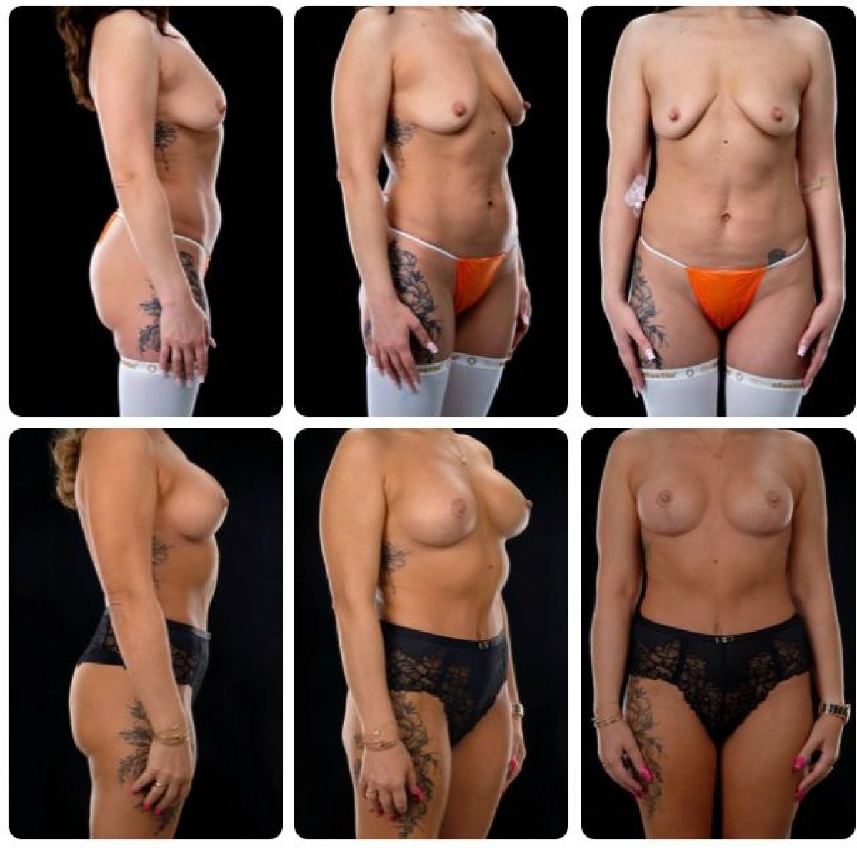 Resultados antes y después de mommy makeover en Yurchenko Plastic Surgery Team, contorno corporal