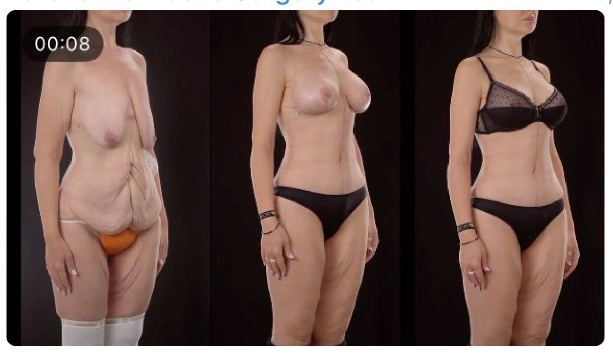 Mommy makeover before and after results at Yurchenko Plastic Surgery Team, body contouring