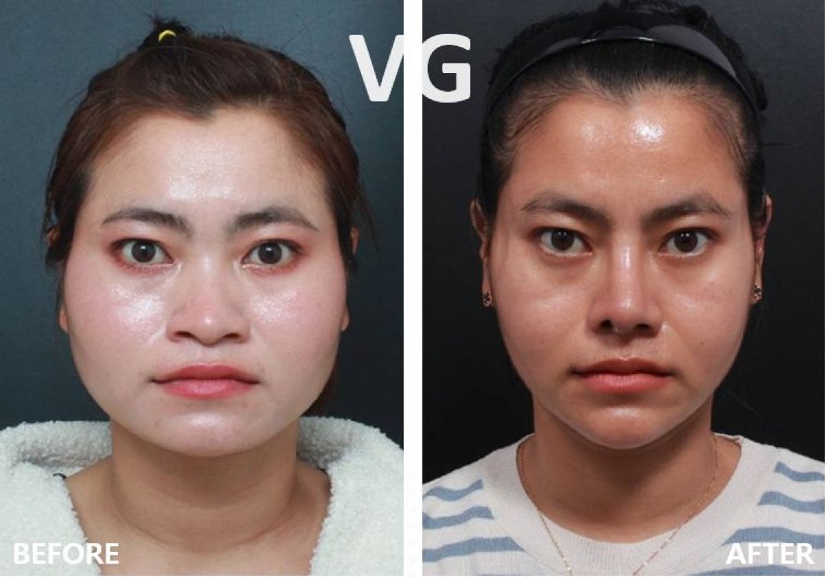 Resultados antes y después de rinoplastia con relleno en VG Plastic Surgery, remodelación nasal