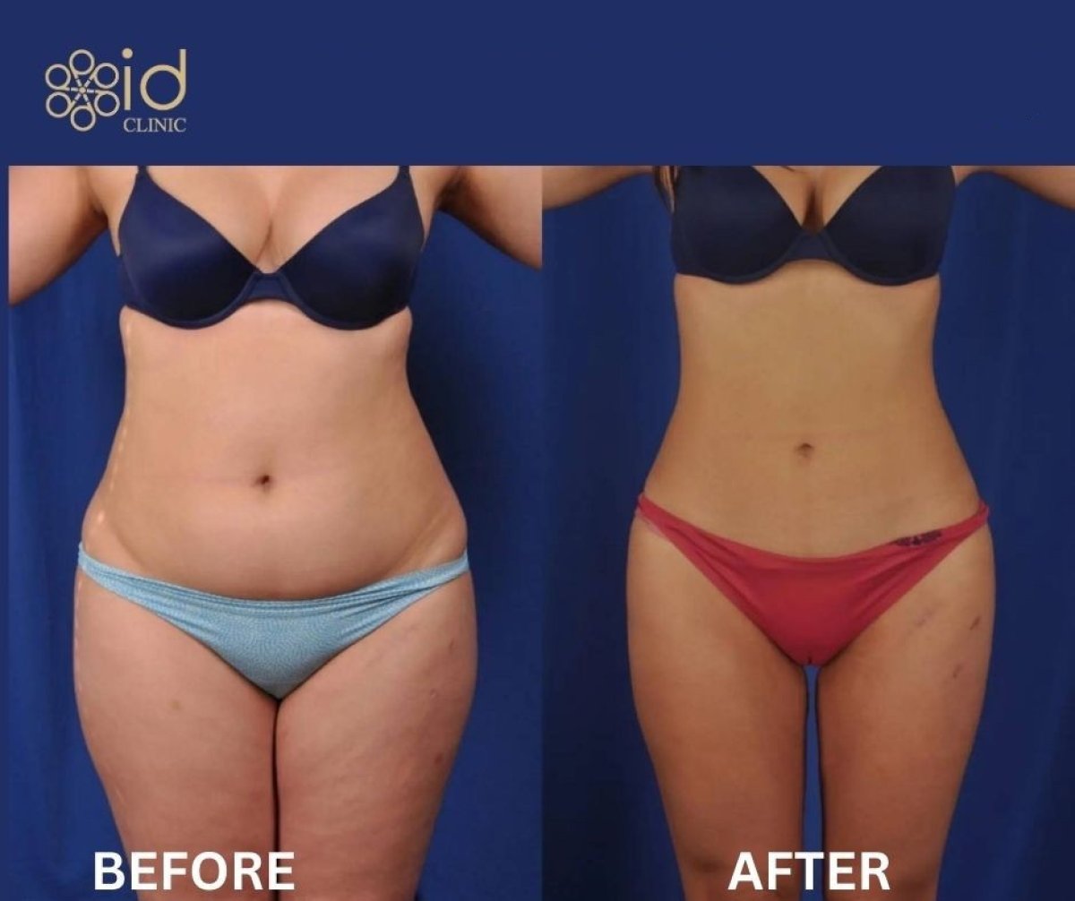 Before and after thigh liposuction results at ID Clinic Bangkok, improved leg contour visible