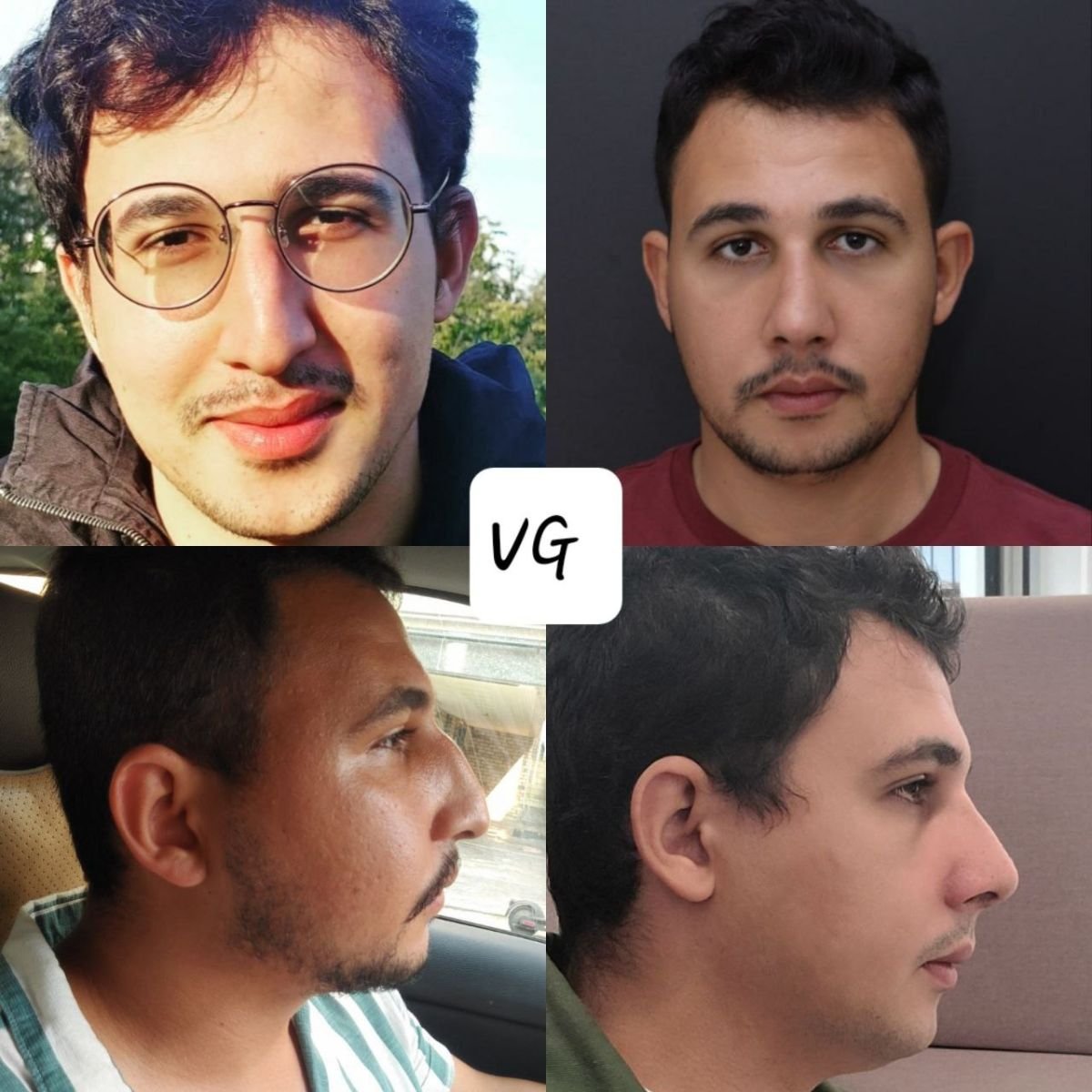 Resultados de septoplastia antes y después en VG Plastic Surgery, mejor simetría y respiración nasal