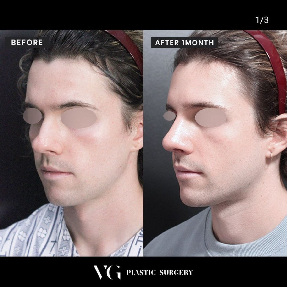 Before and after septoplasty results at VG Plastic Surgery, improved nasal symmetry visible