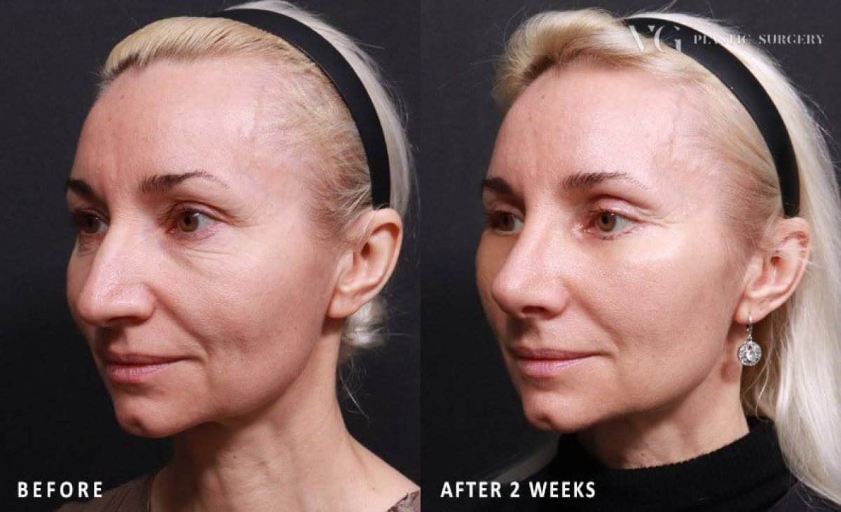 Resultados antes y después de septoplastia en VG Plastic Surgery, mejor forma y respiración nasal