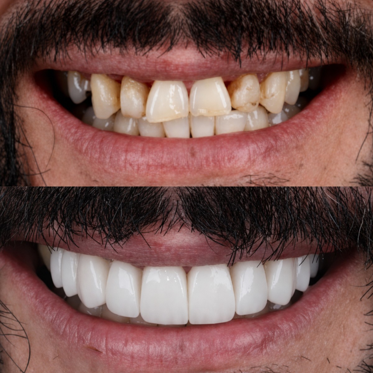 نتيجة قبل وبعد ابتسامة هوليوود في SmileBox Dental Clinic - Thonglor, Sukhumvit