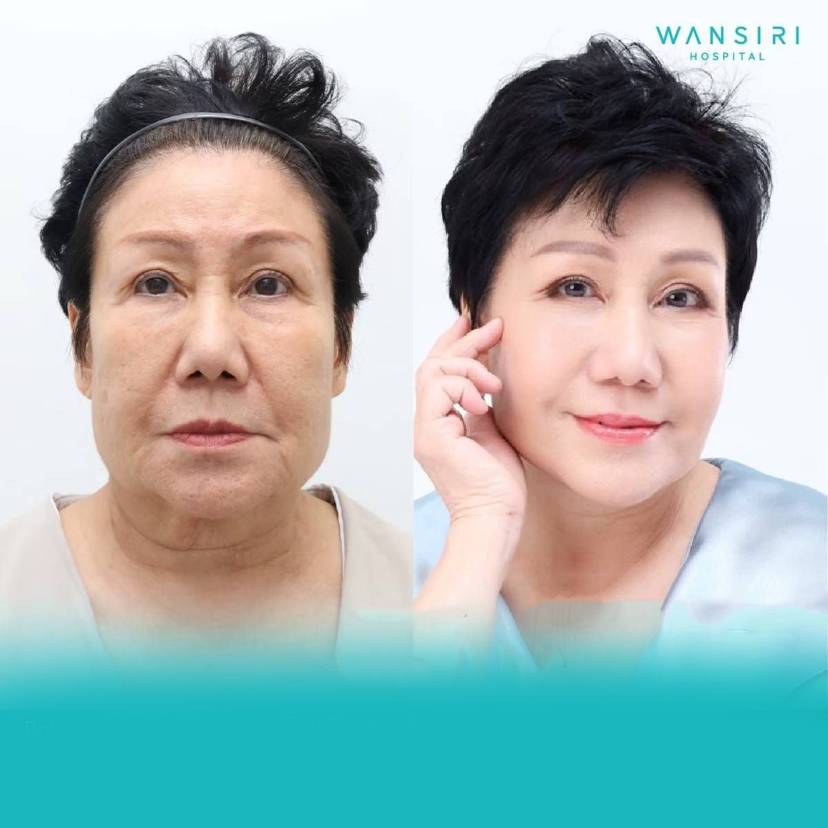 Resultados de minilifting facial antes y después en Wansiri Hospital, rejuvenecimiento facial