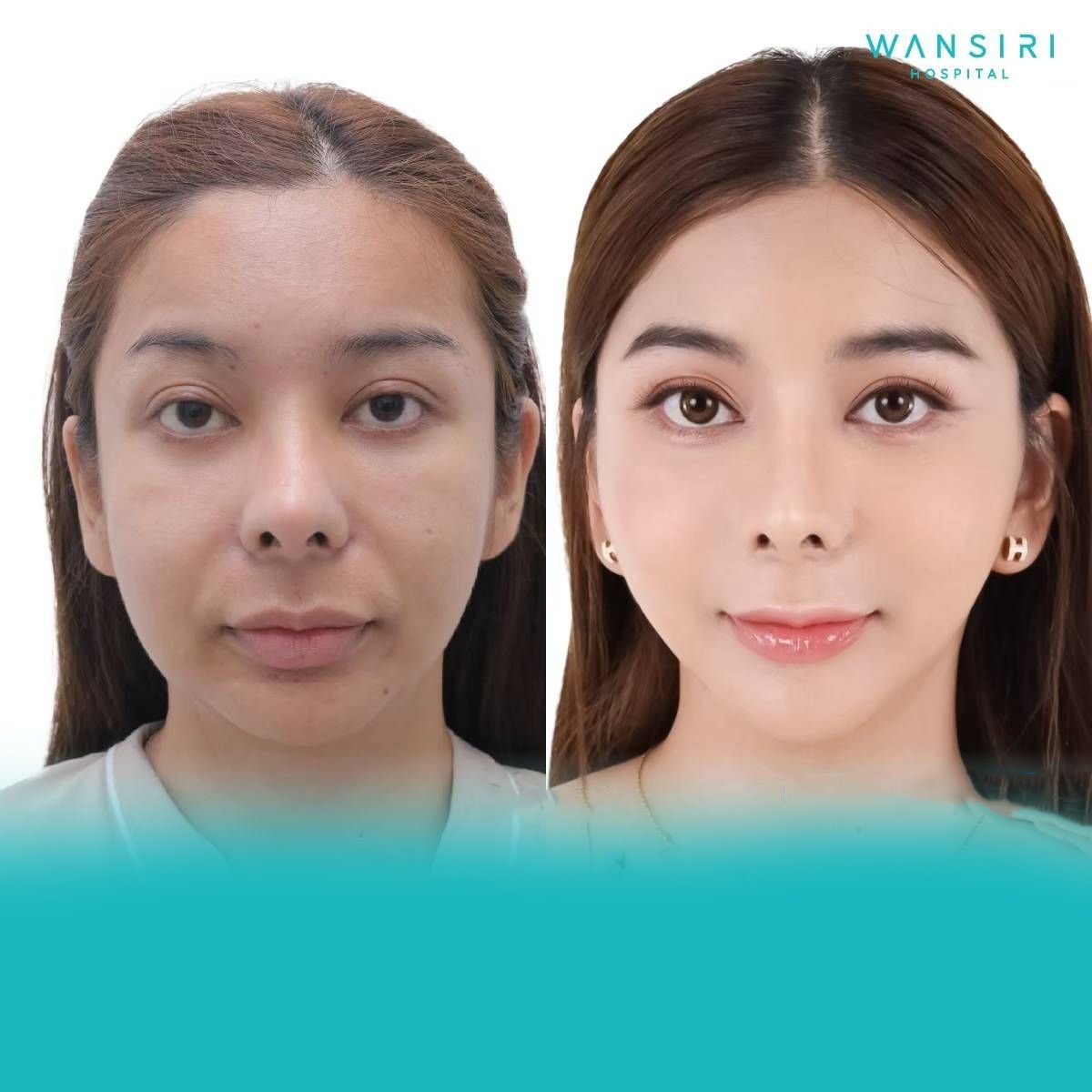 Resultados de minilifting facial antes y después en Wansiri Hospital, rejuvenecimiento facial