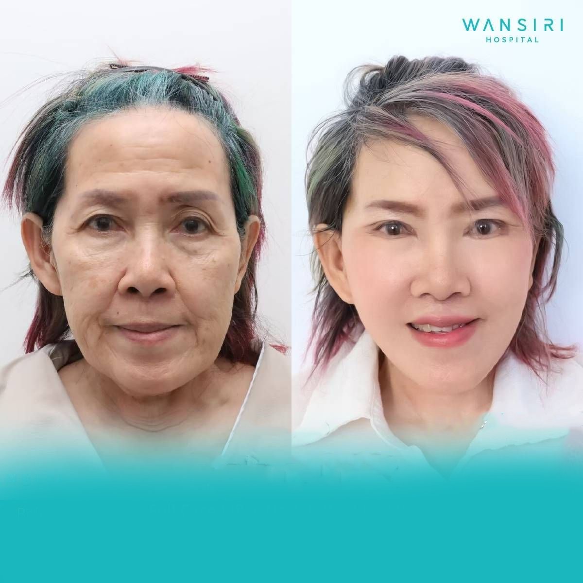 Resultados de minilifting facial antes y después en Wansiri Hospital, rejuvenecimiento facial