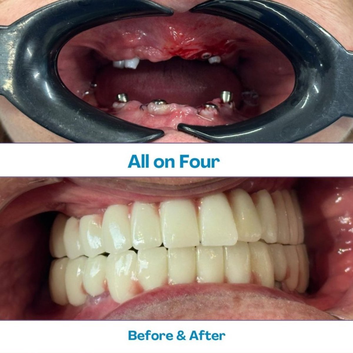 Before and after Zygomatic All-on-4 dental implants result at İstinye Dental Hospital