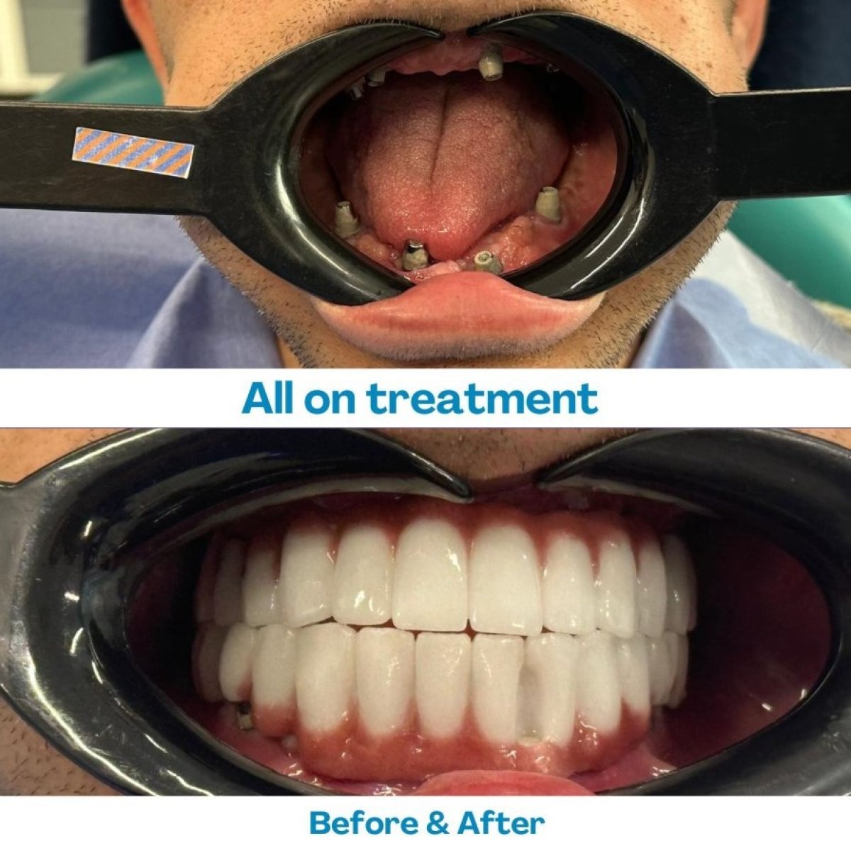 Vorher-nachher-Ergebnis Zygoma All-on-4 Implantate bei İstinye Dental Hospital