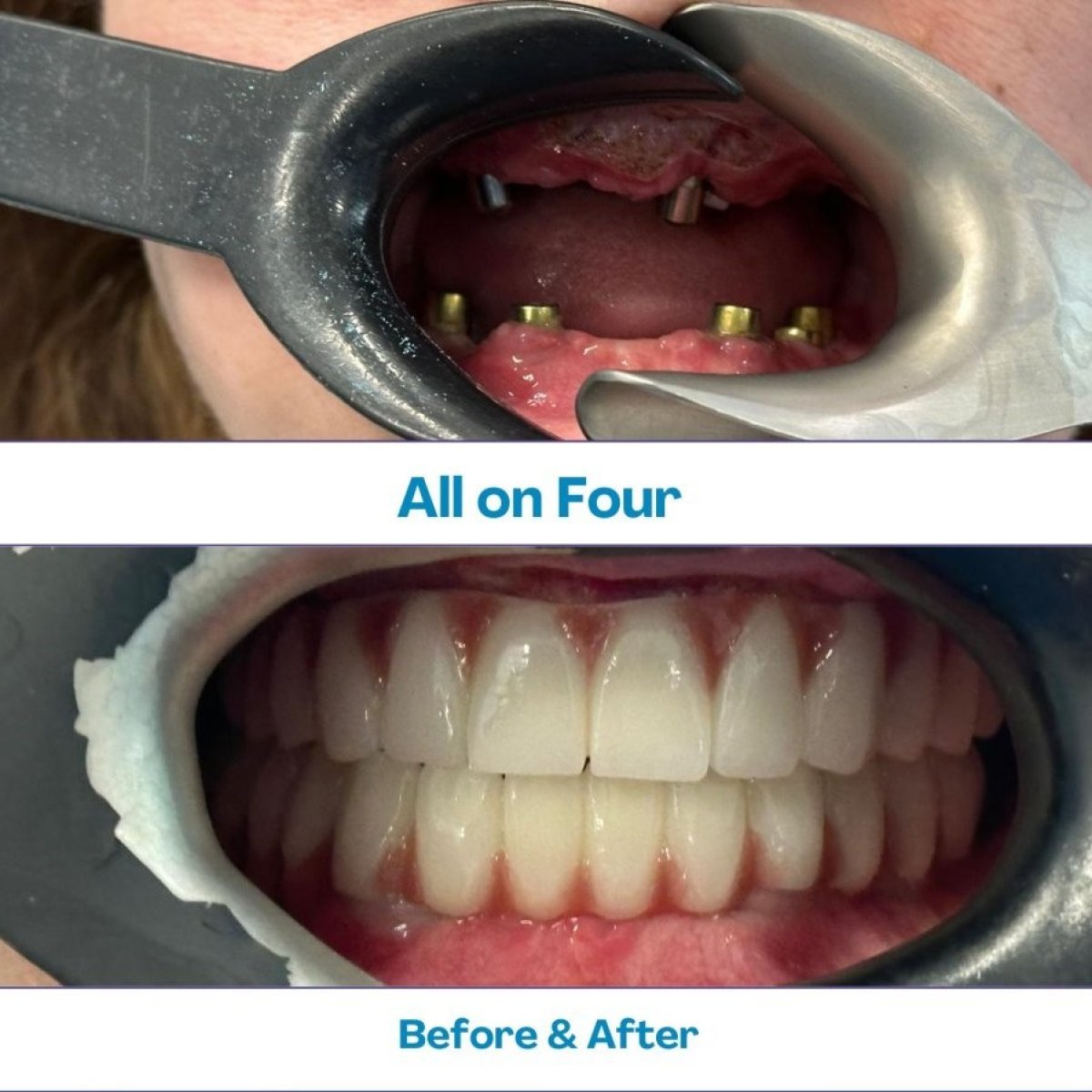 Before and after Zygomatic All-on-4 dental implants result at İstinye Dental Hospital
