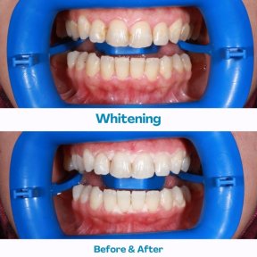 Teeth Whitening