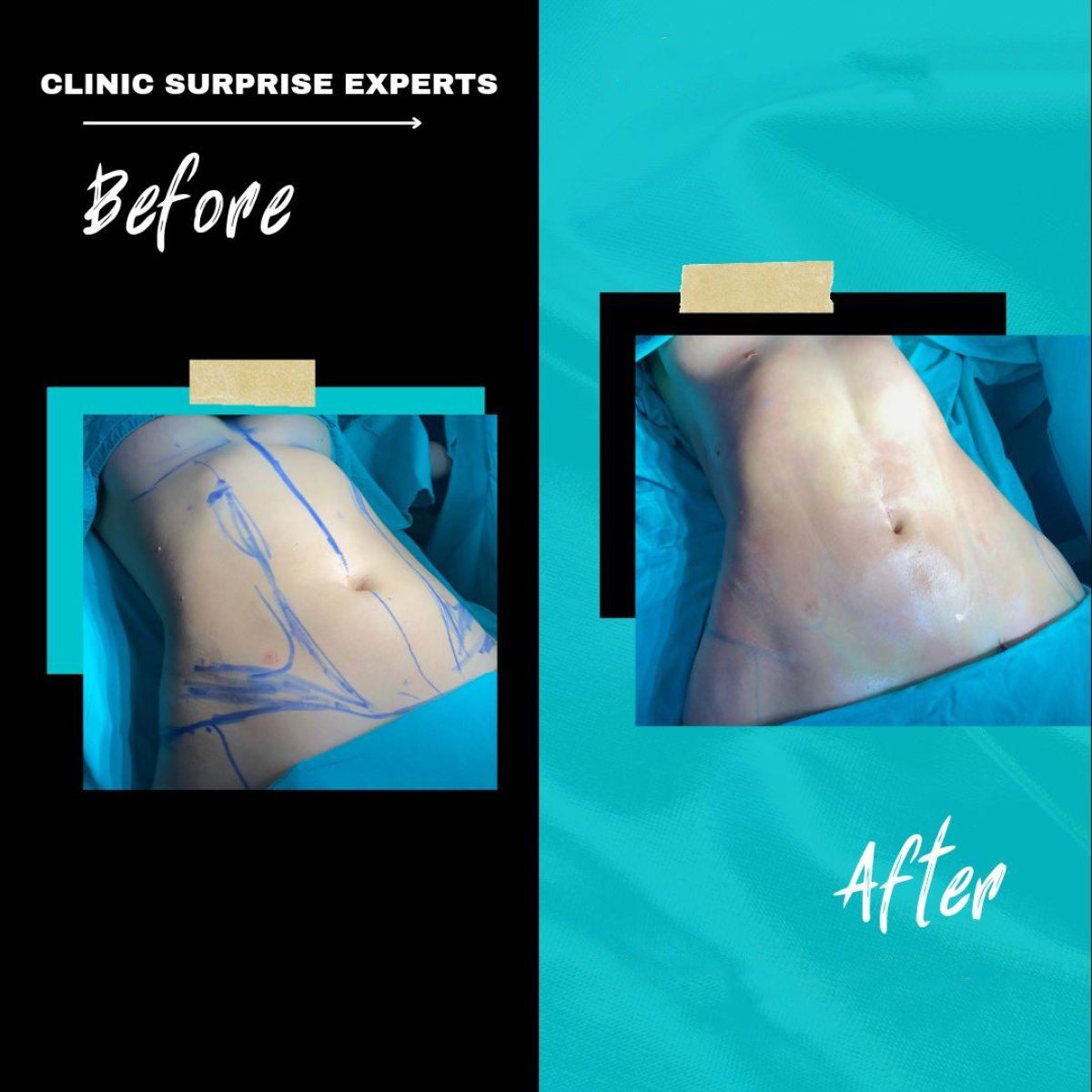 Before and after liposuction results at Surprise Experts Clinic, visible abdominal contouring