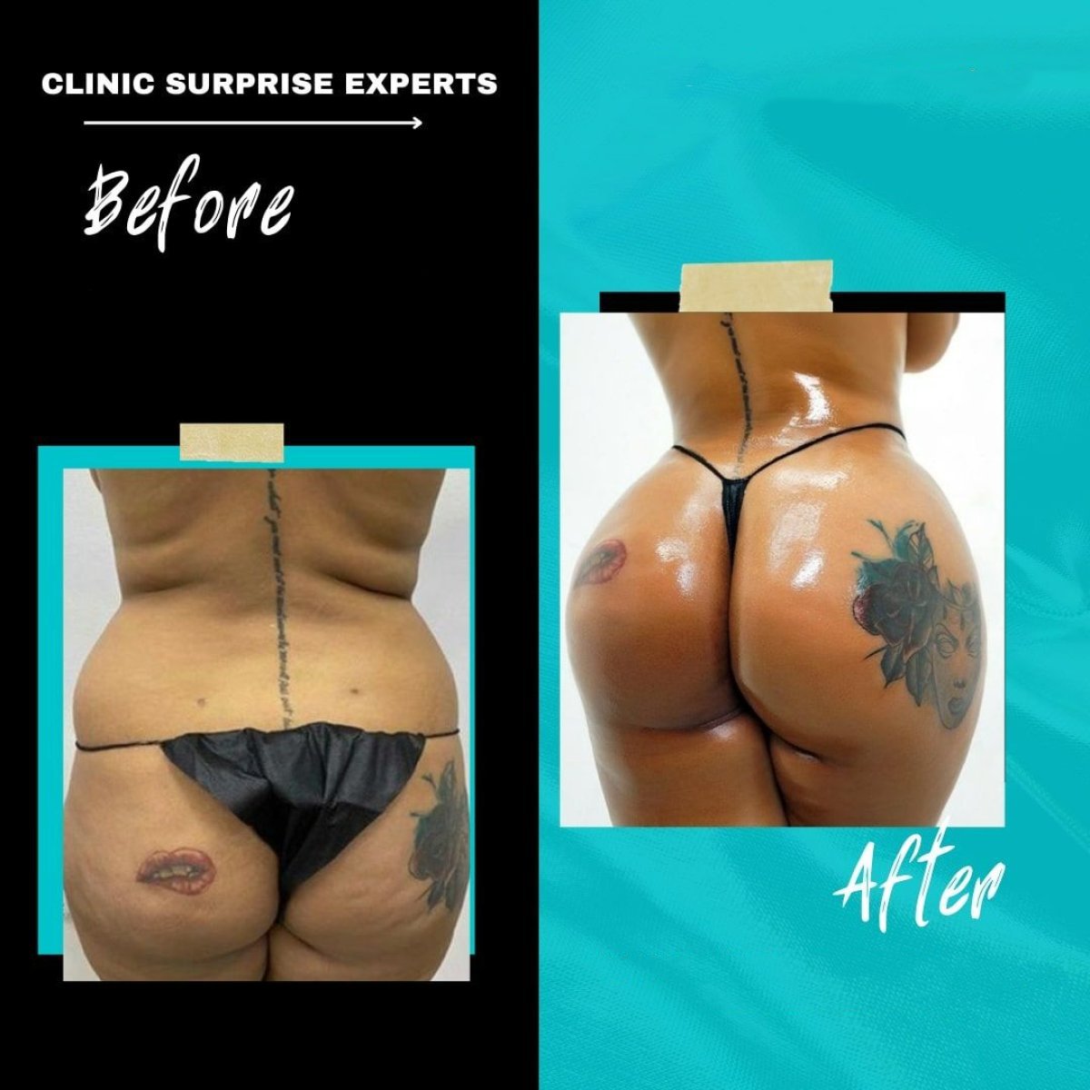 Результати до і після бразильської підтяжки сідниць у Surprise Experts Clinic, помітні форми