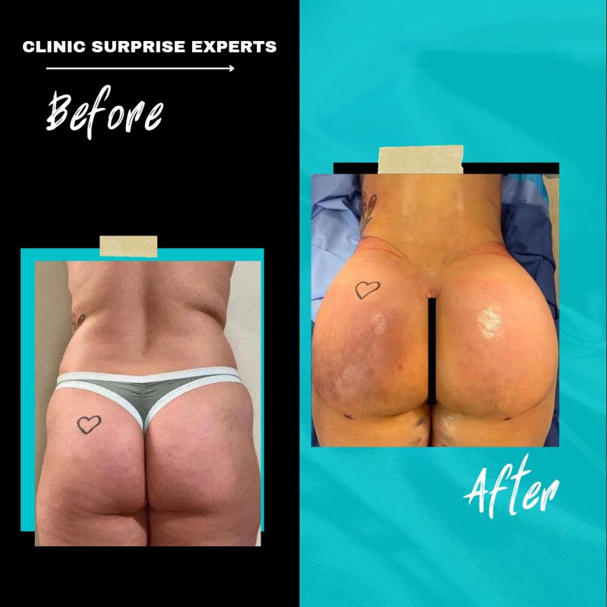 نتائج قبل وبعد عملية شد المؤخرة البرازيلية في Surprise Experts Clinic، تحسين شكل الأرداف