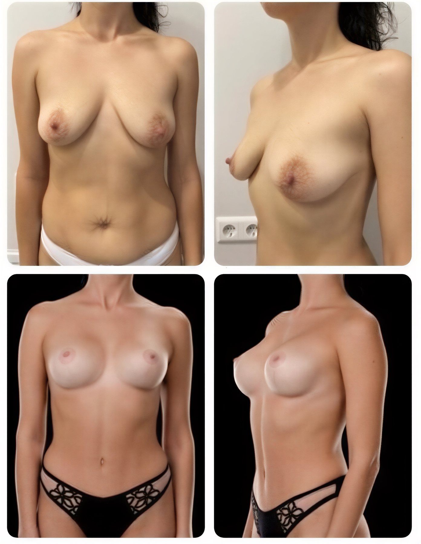 Resultados antes y después de mommy makeover en Yurchenko Plastic Surgery Team, pecho y contorno