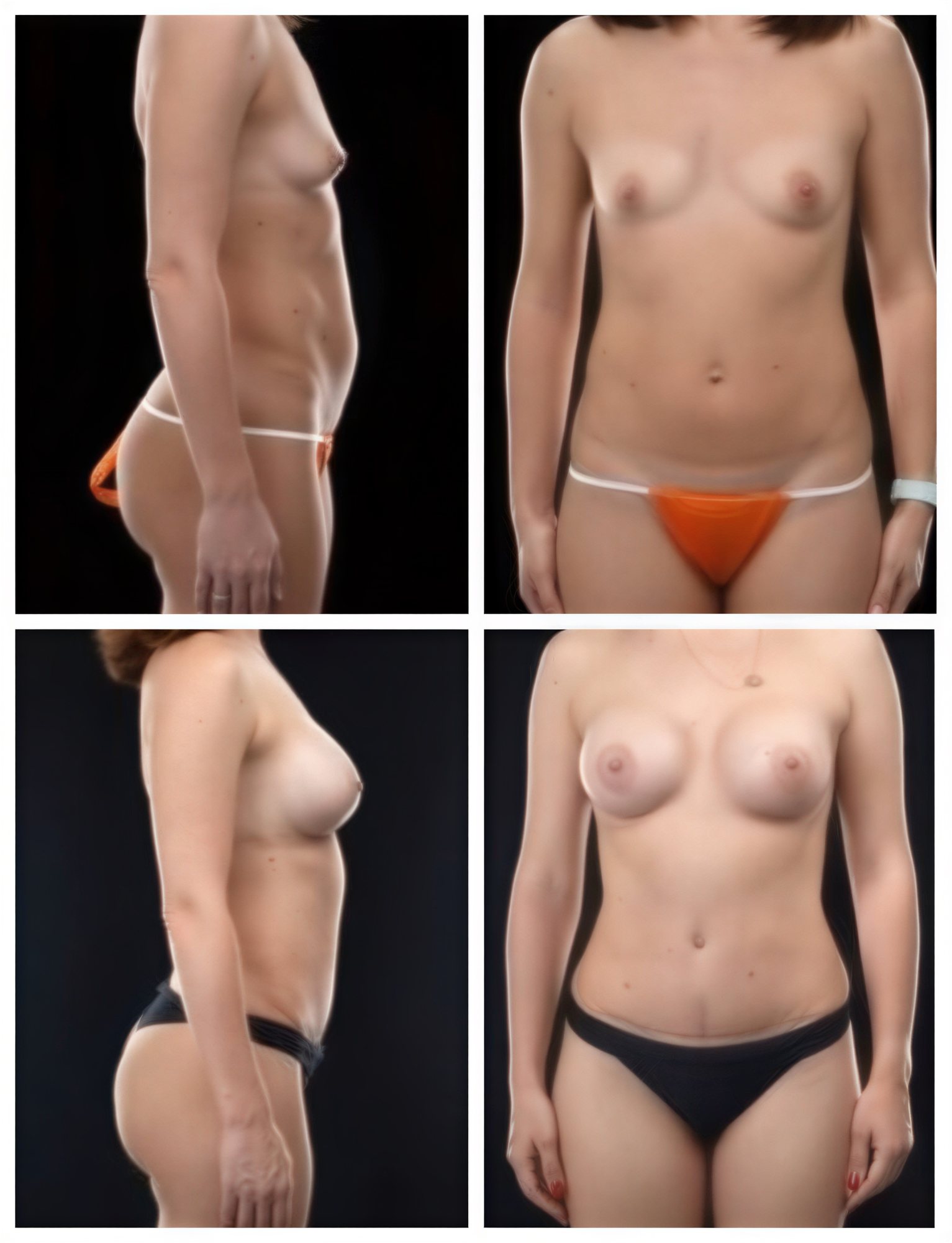 Resultados antes y después de mommy makeover en Yurchenko Plastic Surgery Team, contorno corporal