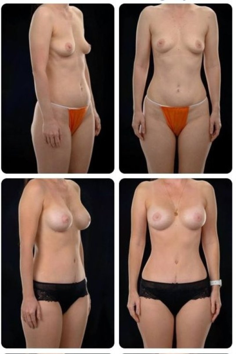 Résultats avant/après mommy makeover chez Yurchenko Plastic Surgery Team, remodelage du corps