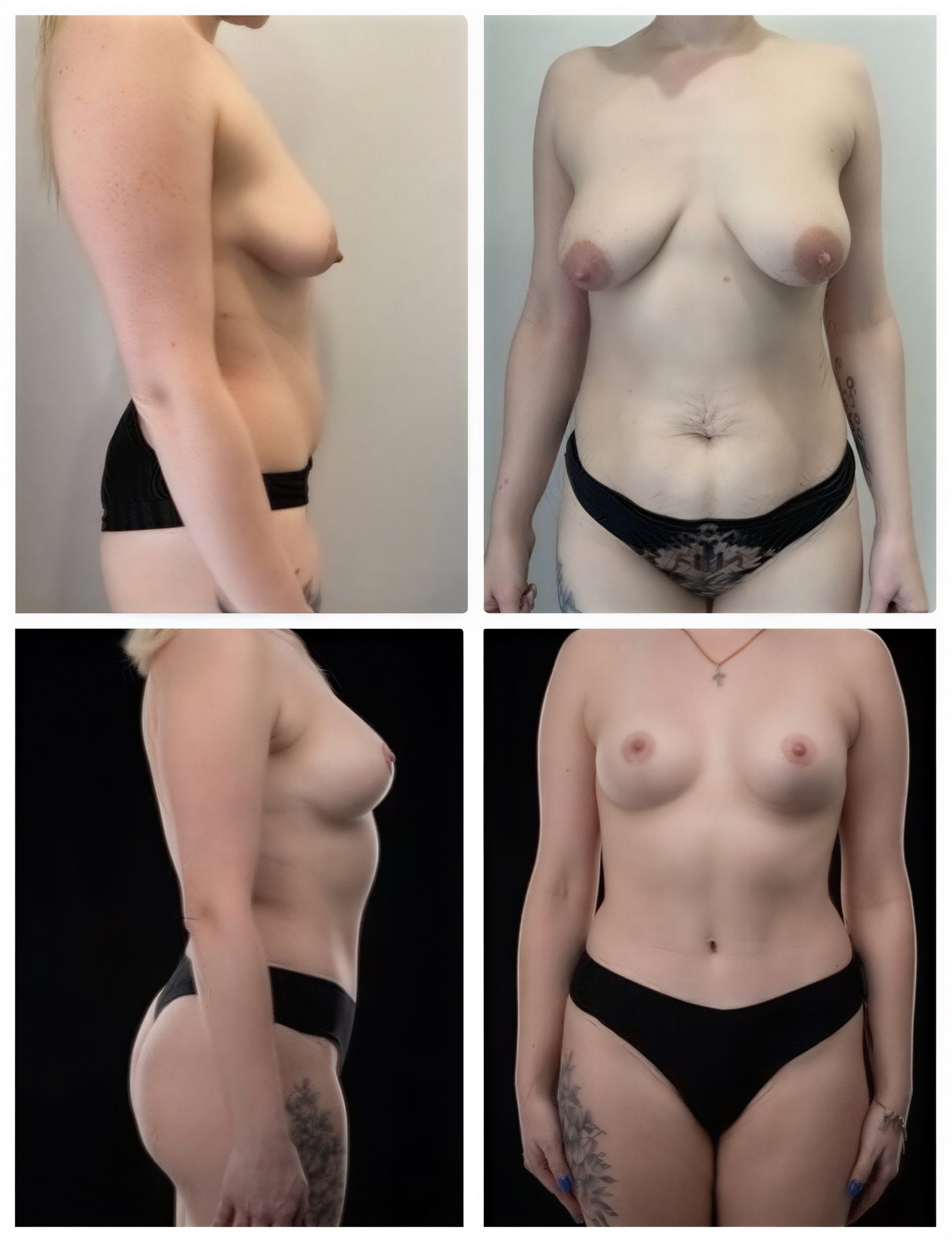 Resultados antes y después de mommy makeover en Yurchenko Plastic Surgery Team, mejor contorno corporal