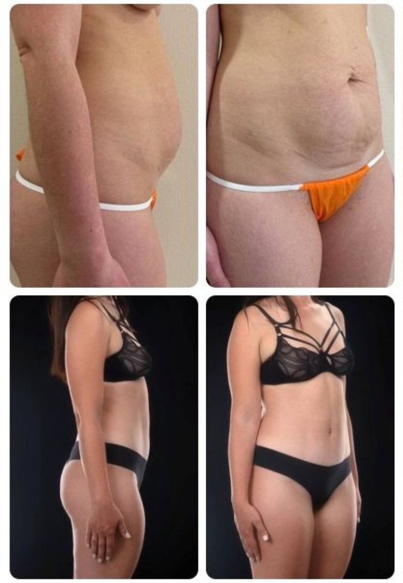 Resultados antes y después de mommy makeover en Yurchenko Plastic Surgery Team, contorno corporal