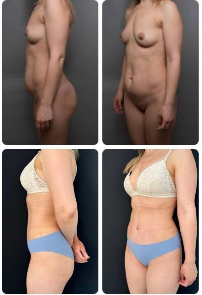 Результаты до и после маммопластики в Yurchenko Plastic Surgery Team, коррекция фигуры