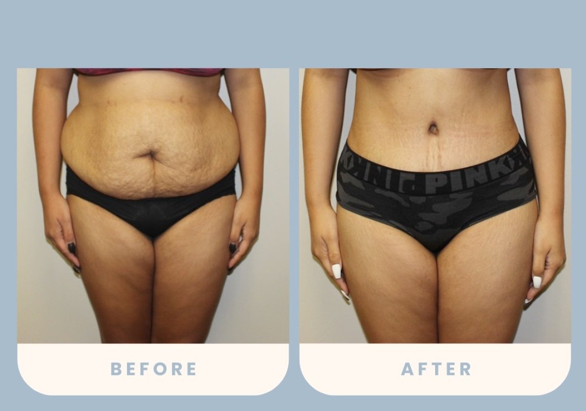Before and after tummy tuck and liposuction results at Estexper Clinic, flatter abdomen
