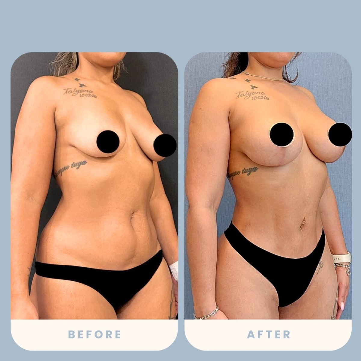 Before and after tummy tuck and liposuction results at Estexper Clinic, body contour improved