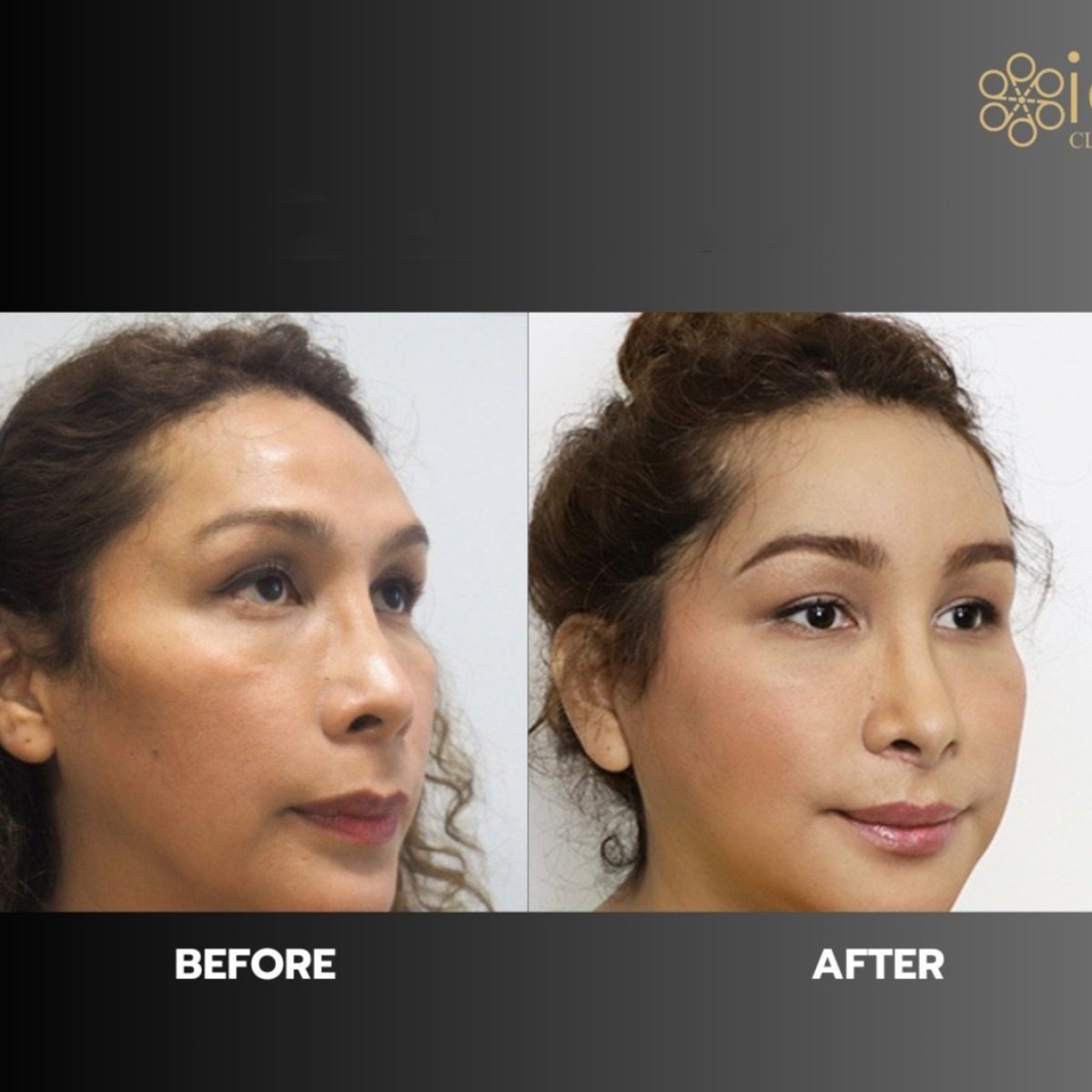 Facelift before and after results at ID Clinic Bangkok, visible facial rejuvenation and lift