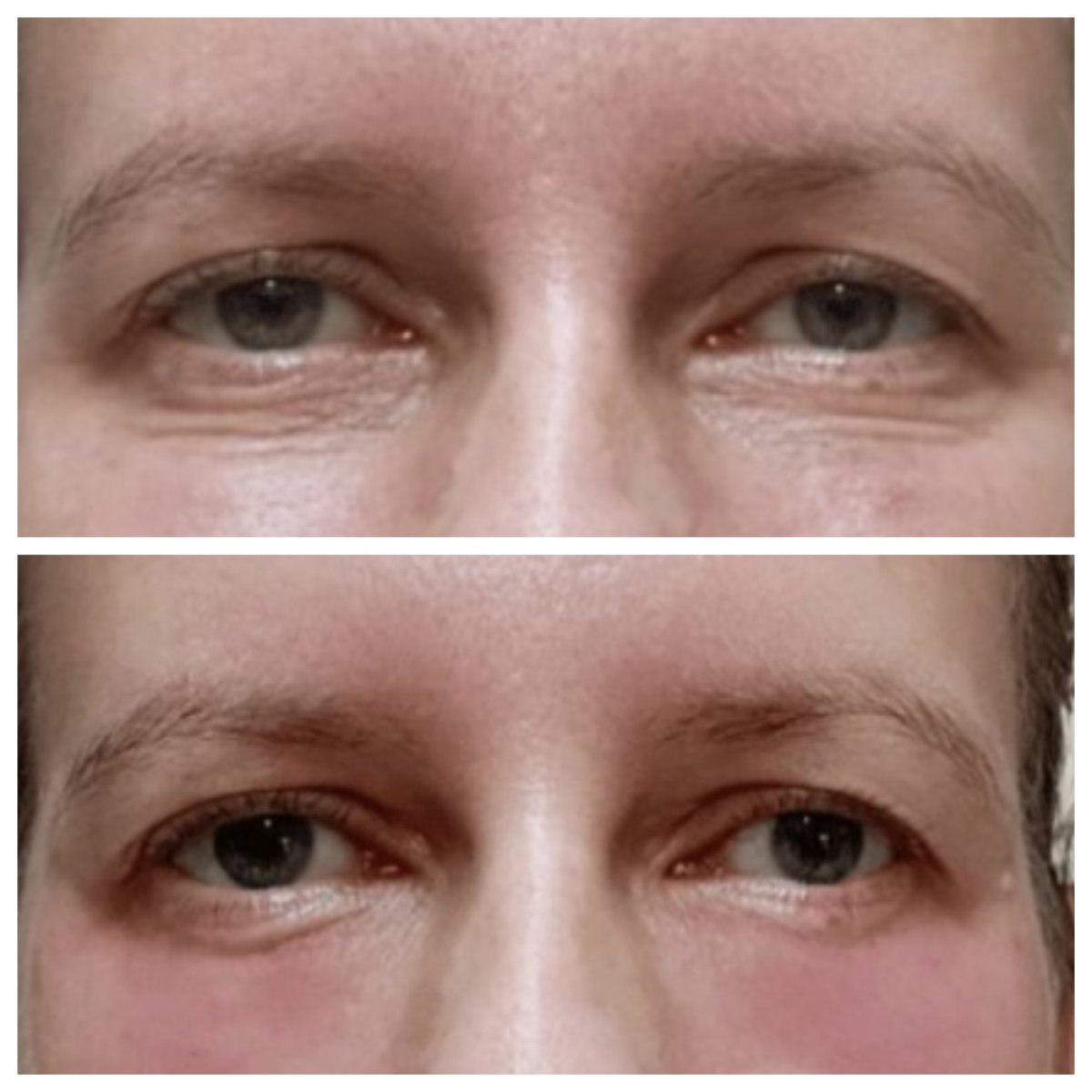 Before and after fillers injection under eyes at Charismma Clinic, reduced dark circles result
