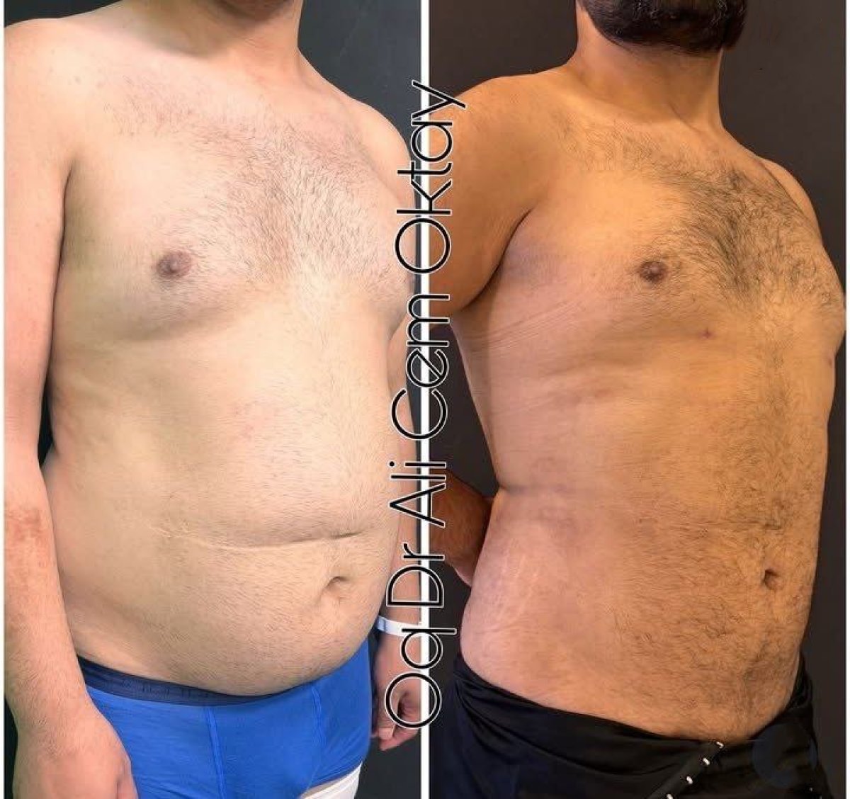 Before and after liposuction results at Adem and Havva Medical Center, improved abdomen contour