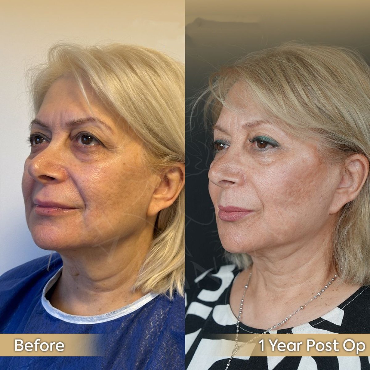 Résultats lifting des sourcils avant/après à la clinique Dr. Safa Manav, front relevé