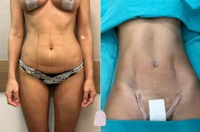 Tummy Tuck with Vaser Liposuction, Diastases Correction ALL INCLUDED Package with DR MED High Rated Clinic - photo 6