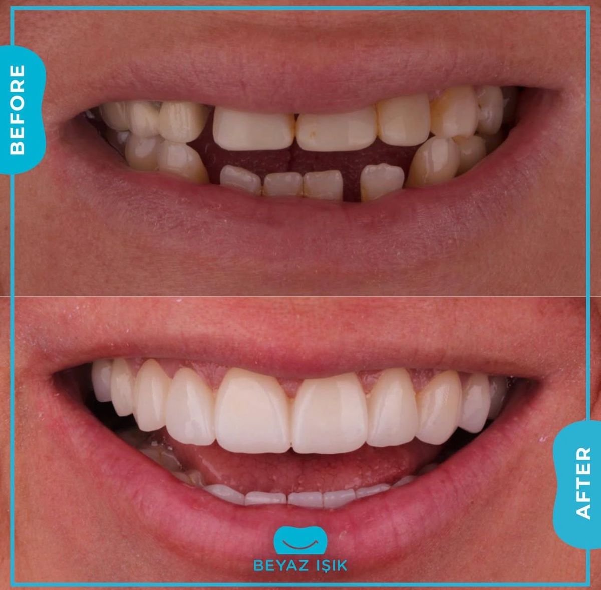 نتائج قبل وبعد تجميل الأسنان بالترابط في Adem and Havva Medical Center، ابتسامة محسنة