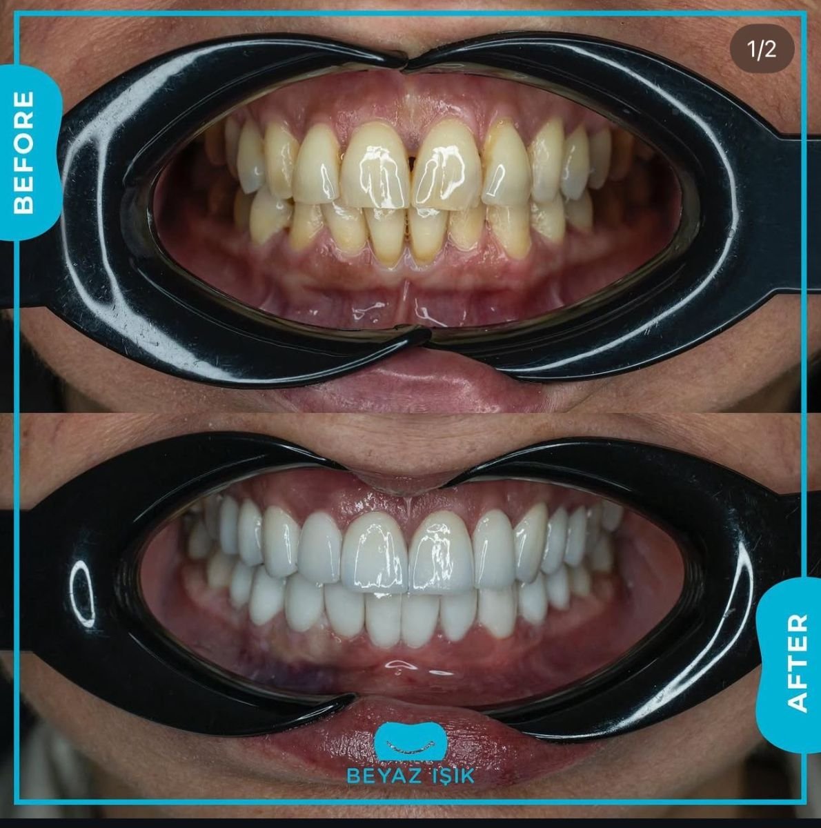 نتائج قبل وبعد تجميل الأسنان في Adem and Havva Medical Center، تحسين مظهر الابتسامة