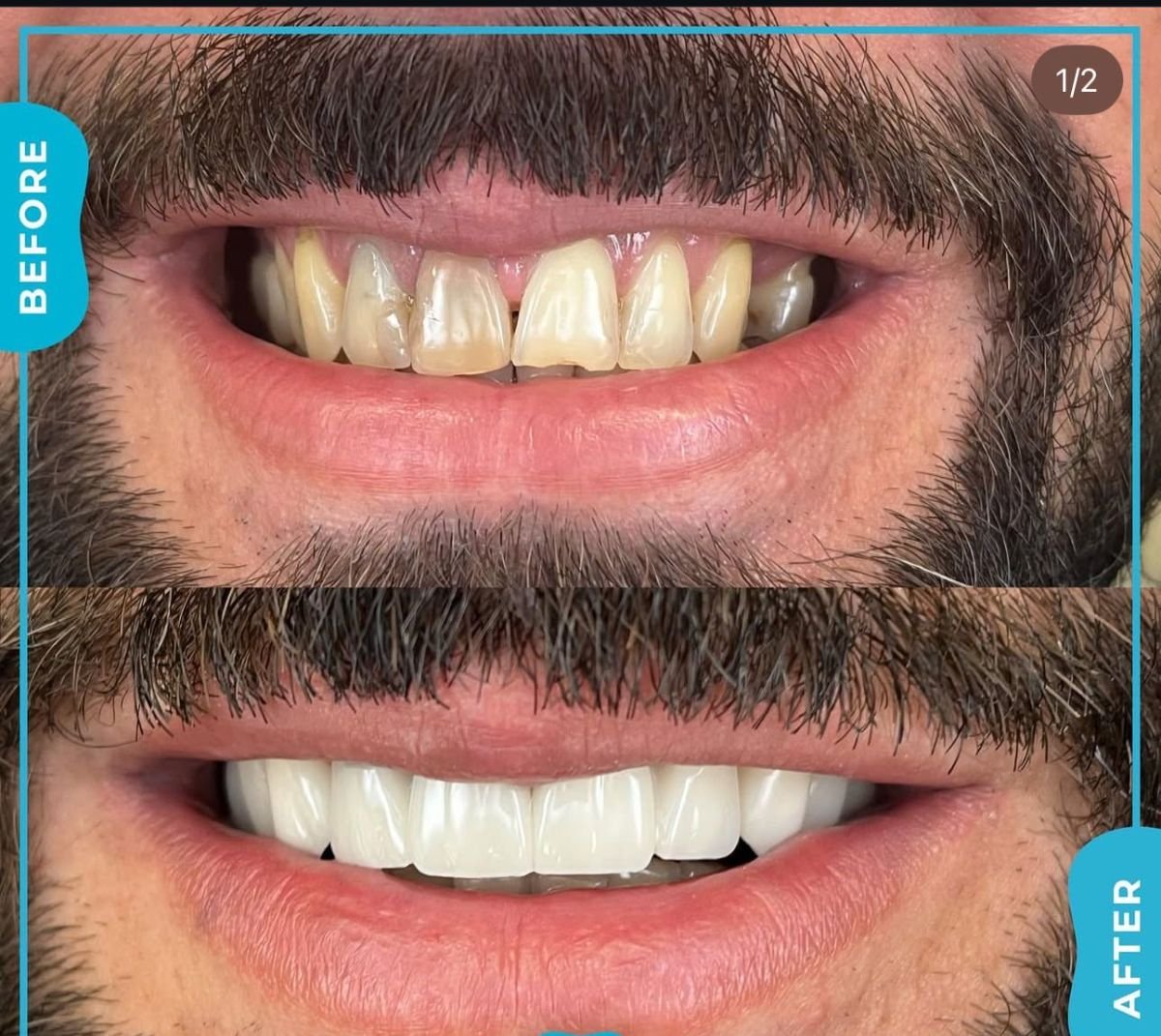 نتائج قبل وبعد تجميل الأسنان بالترابط في Adem and Havva Medical Center، ابتسامة محسنة