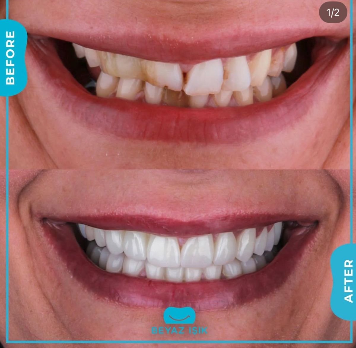 نتائج قبل وبعد تجميل الأسنان بالترابط في Adem and Havva Medical Center، ابتسامة محسنة