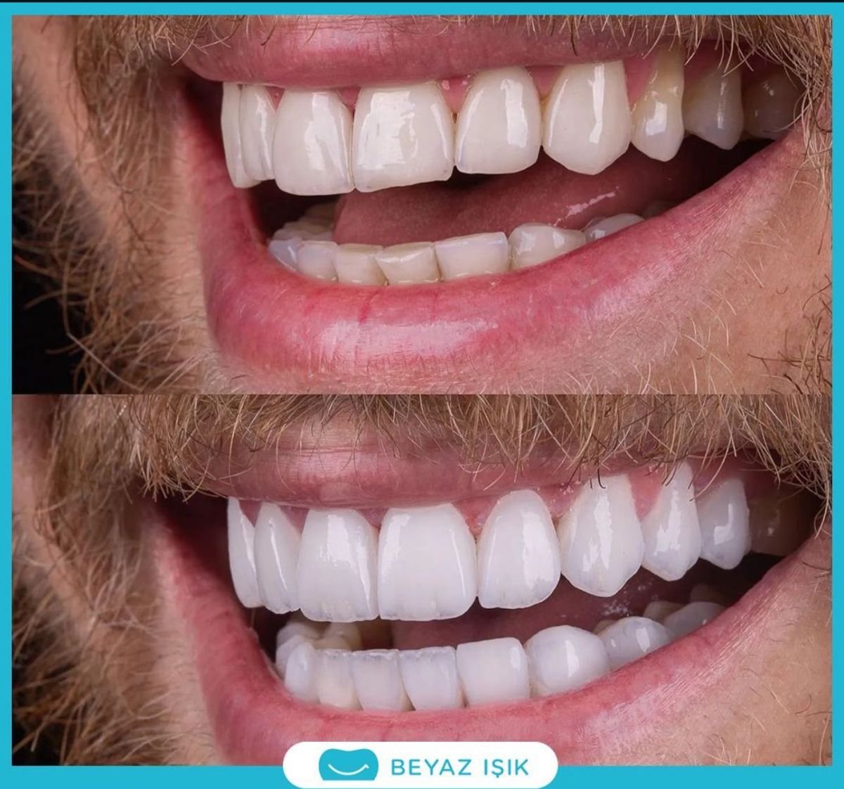 نتائج قبل وبعد ترابط الأسنان في Adem and Havva Medical Center، ابتسامة محسنة