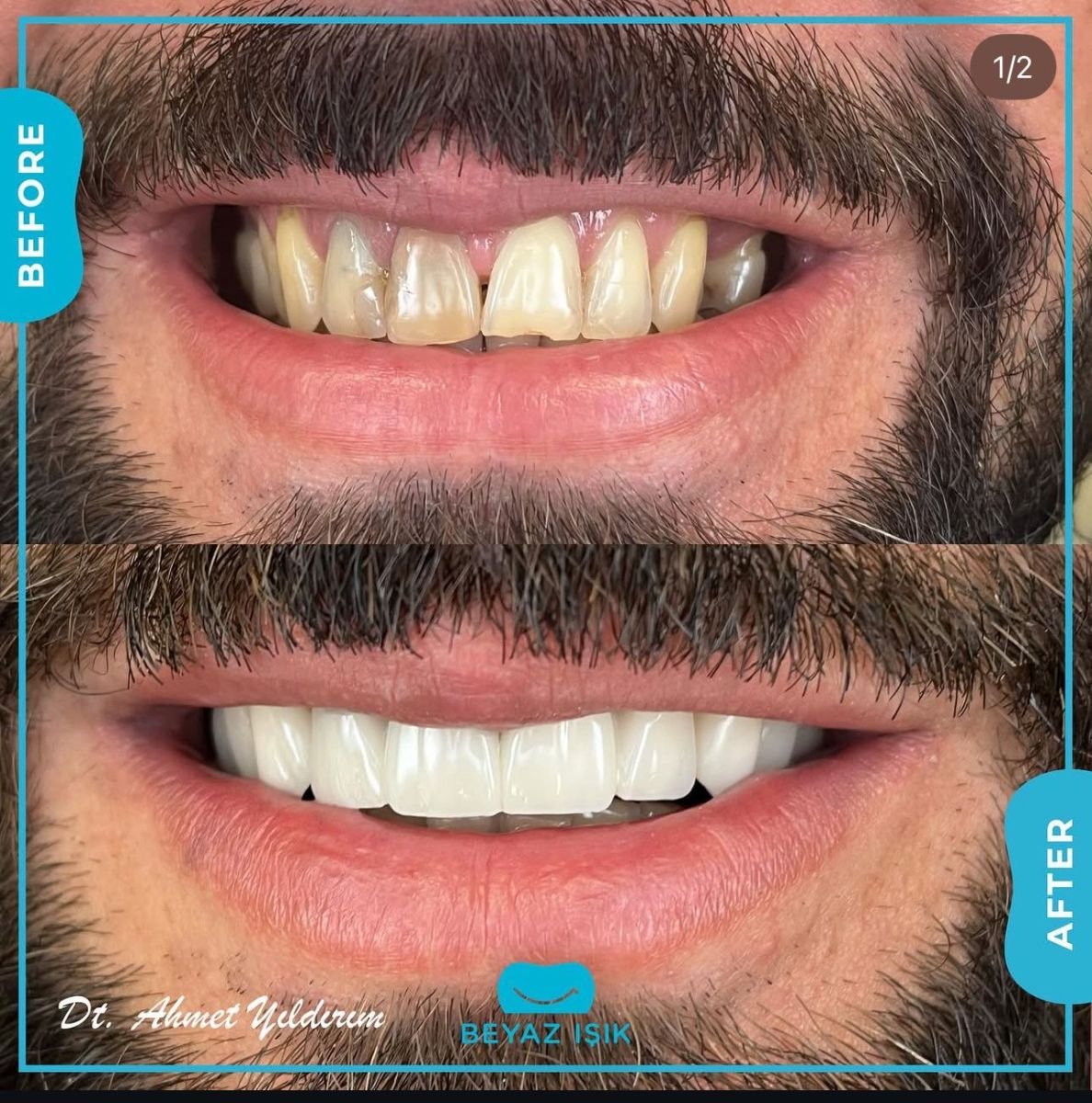 نتائج قبل وبعد تجميل الأسنان بالترابط في Adem and Havva Medical Center، ابتسامة محسنة