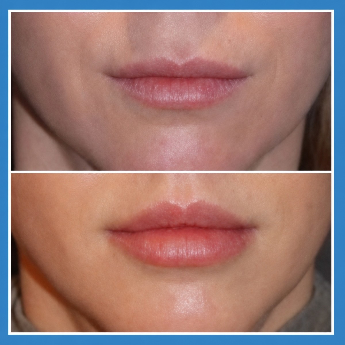 Before and after lip lift results at ID Clinic Bangkok, enhanced upper lip contour visible