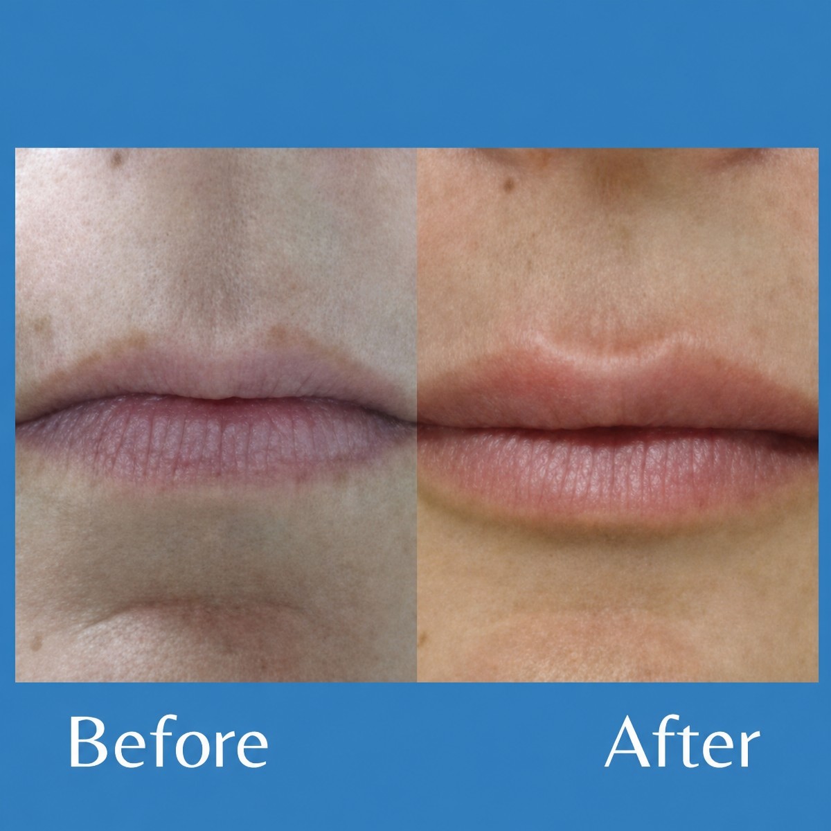 Before and after lip lift results at ID Clinic Bangkok, enhanced lip contour and shape